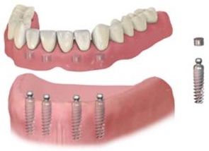 Hàm tháo lắp toàn hàm kết hợp với chốt đúc nam châm